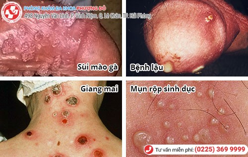 Hình ảnh 1 số bệnh nổ bô ở nam Hình ảnh 1 số bệnh nổ bô ở nam