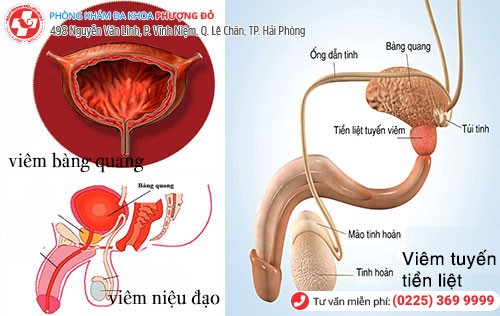 tiểu rắt là dấu hiệu bệnh tiết niệu