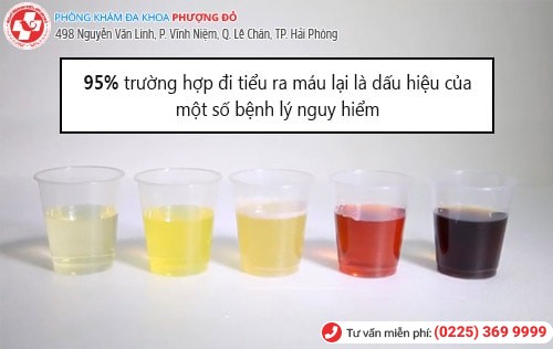 Tiểu ra máu là mắc bệnh gì? Giải đáp chi tiết từ bác sĩ chuyên khoa