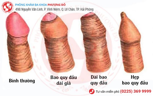 Các dạng bao quy đầu cần phải cắt Các dạng cần cắt bao quy đầu