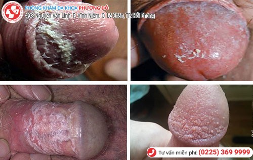 Hình ảnh bao quy đầu bị nấm Hình ảnh bao quy đầu bị nấm