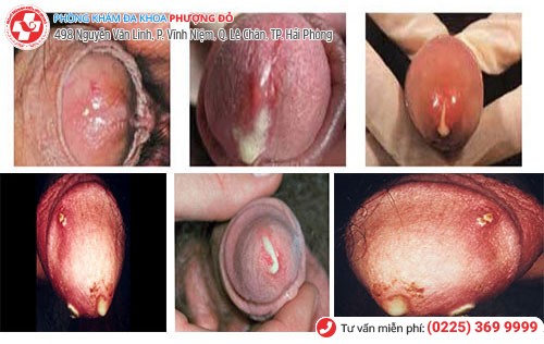 Hình ảnh đầu dương vật chảy dịch Hình ảnh đầu dương vật chảy dịch