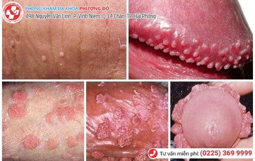 Dương vật nổi mẩn đỏ là dấu hiệu nhiều bệnh nguy hiểm Dương vật nổi mẩn đỏ là dấu hiệu nhiều bệnh nguy hiểm