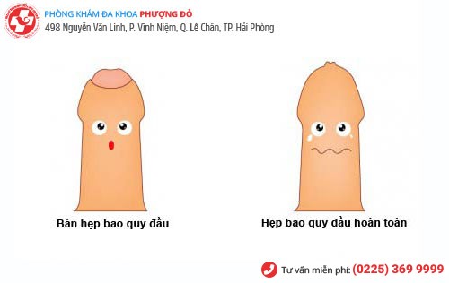 hẹp bao quy đầu