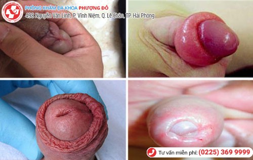 Cận cảnh tình trạng sưng bao quy đầu ở nam giới Hình ảnh sưng bao quy đầu