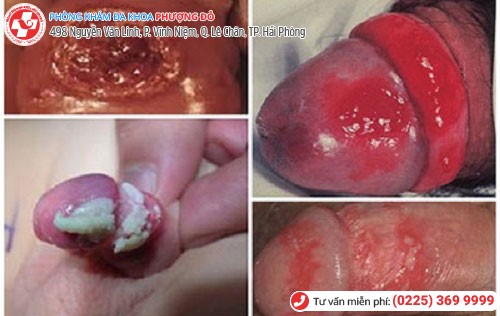 Loét dương vật do nhiều bệnh gây nên Loét dương vật do nhiều bệnh gây nên