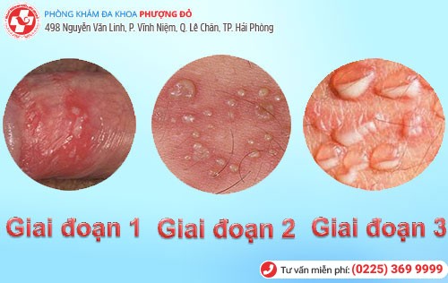 biểu hiện mụn rộp dương vật