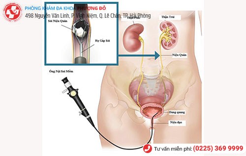 Tán sỏi bằng laser áp  dụng với các trường hợp bị sỏi tuyến tiền liệt ở mức độ nặng