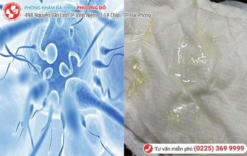Hình ảnh tinh trùng vón cục Hình ảnh tinh trùng vón cục