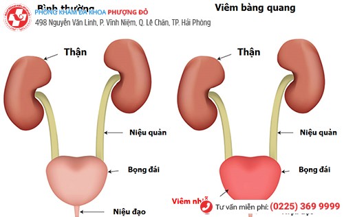 hình ảnh viêm bàng quang