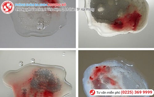 Hình ảnh xuất tinh ra máu Hình ảnh xuất tinh ra máu