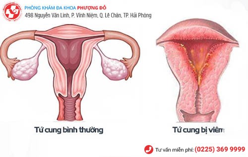 bệnh viêm tử cung