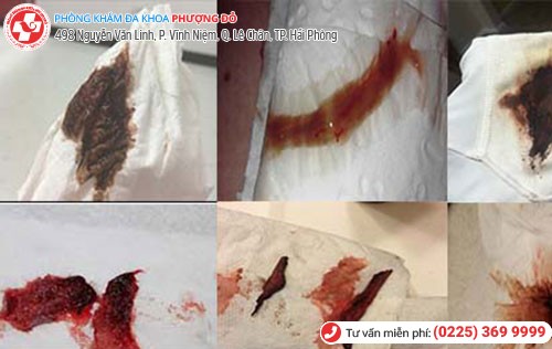 Nhiều bệnh nguy hiểm liên quan đến tình trạng chất nhầy màu nâu đen Nhiều bệnh nguy hiểm liên quan đến tình trạng chất nhầy màu nâu đen