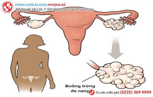 đa nang buồng trứng