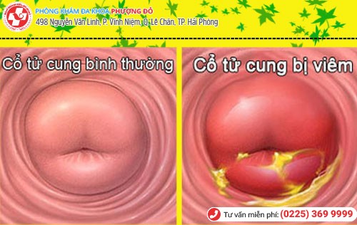 Dấu hiệu viêm cổ tử cung