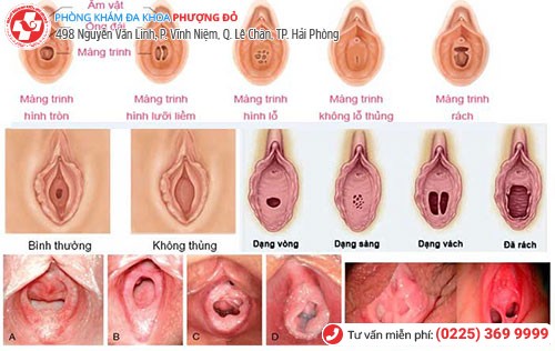 Hình ảnh màng trinh