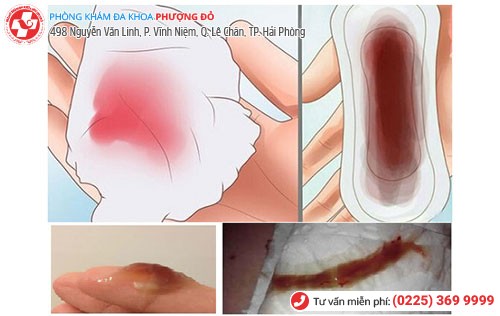 Khí hư có màu nâu là dấu hiệu nhiều bệnh nguy hiểm Khí hư có màu nâu là dấu hiệu nhiều bệnh nguy hiểm