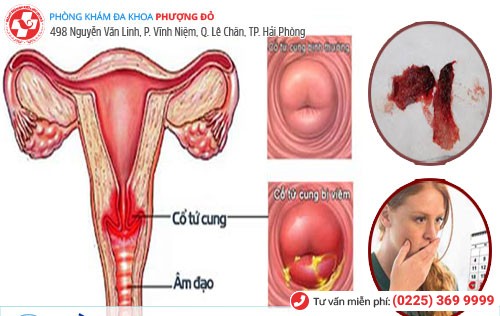 Các bệnh tử cung, cổ tử cung khiến kinh nguyệt có mùi hôi tanh Các bệnh tử cung, cổ tử cung khiến kinh nguyệt có mùi hôi tanh