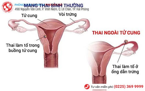 Nguy cơ mang thai ngoài tử cung do viêm vùng chậu