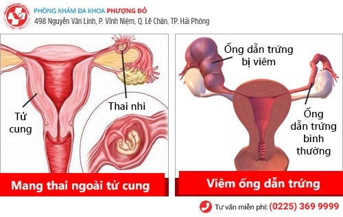 Nhận biết nhanh các dấu hiệu viêm vùng chậu nữ