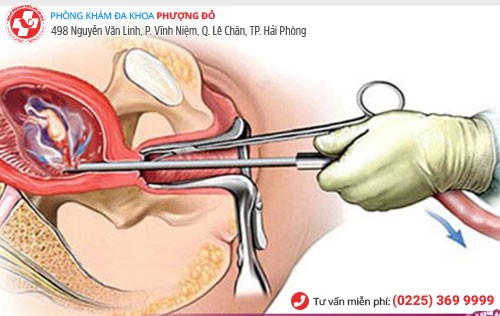 Nong và gắp thai - phương pháp phá thai lớn hiệu quả