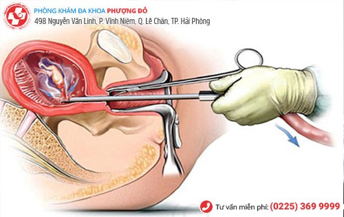 Phá thai bằng hút chân không