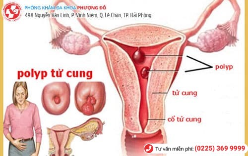 polyp tử cung