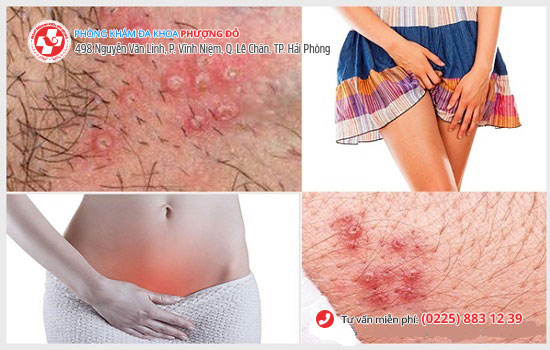 Nhiều trường hợp quan hệ bị ngứa được Phòng Khám Phượng Đỏ tiếp nhận