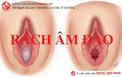 Rách âm đạo do nhiều nguyên nhân khác nhau gây nên Rách âm đạo do nhiều nguyên nhân khác nhau gây nên