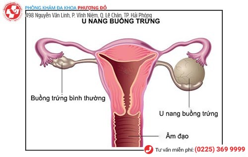 Hình ảnh u nang buồng trứng Hình ảnh u nang buồng trứng