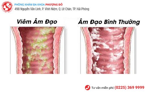 Biểu hiện viêm âm đạo