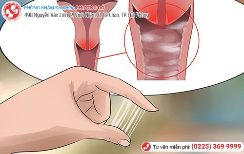 Âm đạo ra nước - dấu hiệu bệnh viêm âm đạo Âm đạo ra nước - dấu hiệu bệnh viêm âm đạo