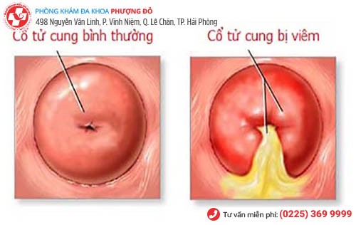 Viêm cổ tử cung