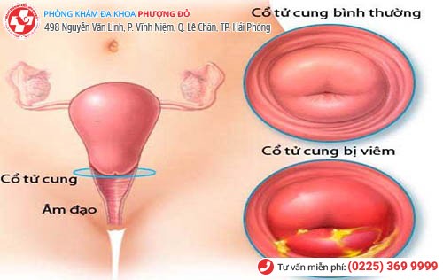 Bệnh viêm cổ tử cung