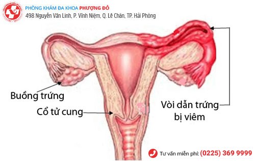 Bệnh viêm vòi trứng Viêm vòi trứng