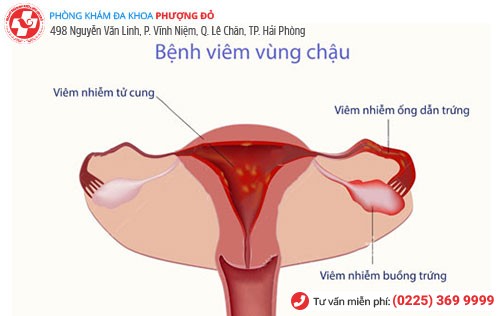 Viêm vùng chậu viêm âm đạo