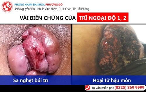 Bệnh trĩ ngoại độ 1, độ 2: Cần chữa ngay để tránh biến chứng