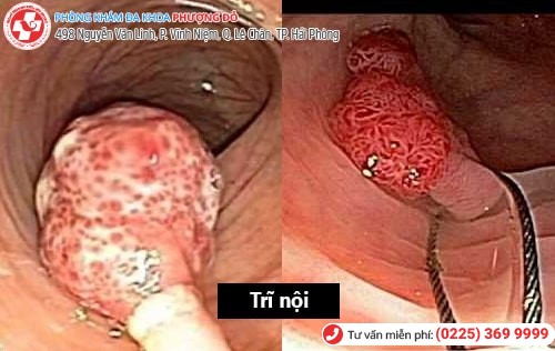 Cách phân biệt trĩ nội trĩ ngoại đơn giản, chính xác nhất 