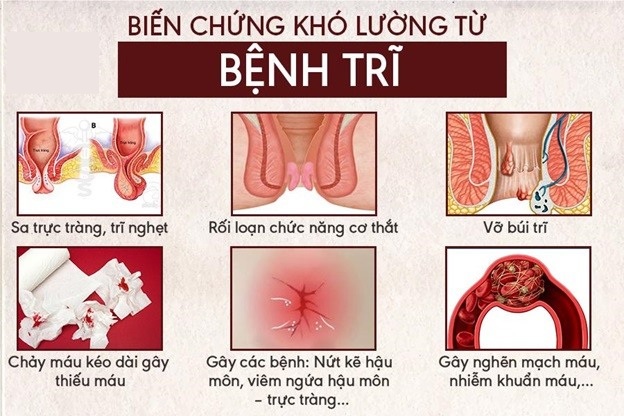 chữa bệnh trĩ