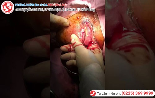 Nguy cơ hoại tử hậu môn do hậu môn viêm nhiễm Nguy cơ hoại tử hậu môn do hậu môn viêm nhiễm