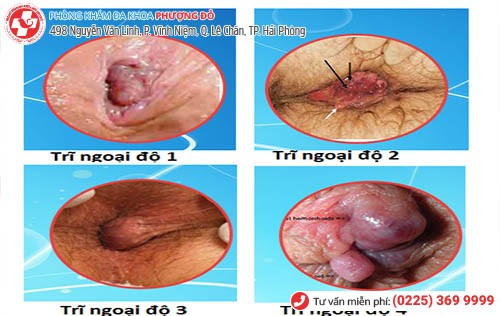 Trĩ ngoại bốn cấp