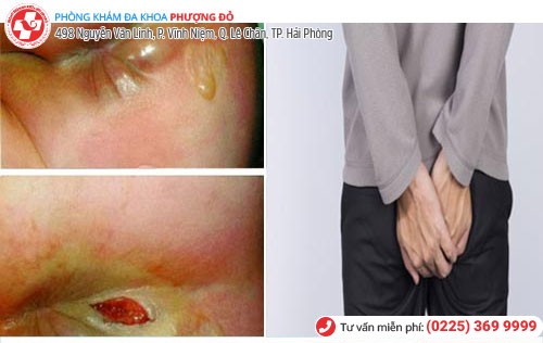 Viêm hậu môn do nhiều nguyên nhân gây nên Viêm hậu môn do nhiều nguyên nhân gây nên