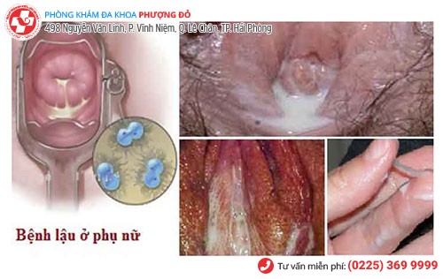 Âm đạo chảy mủ do mắc bệnh lậu Âm đạo chảy mủ do mắc bệnh lậu