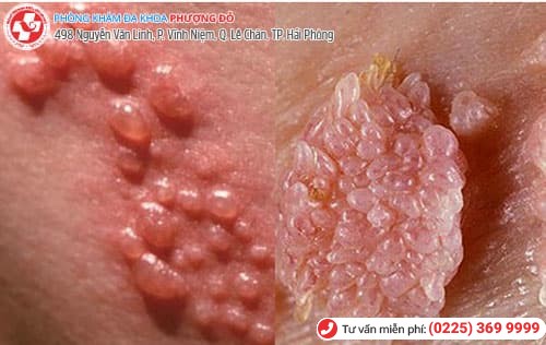 bệnh chào mào hoa khế bệnh chào mào hoa khế