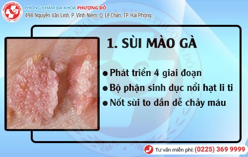 Sùi mào gà Bệnh hoa liễu sùi mào gà