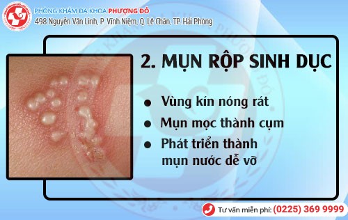Mụn rộp sinh dục Bệnh hoa liễu mụn rộp sinh dục