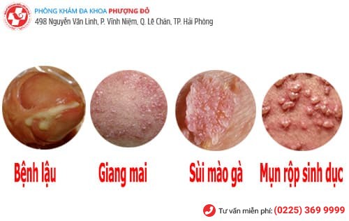 bệnh lây qua đường tình dục