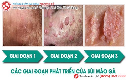 sùi mào gà sùi mào gà