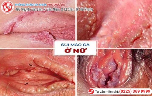 Bị sùi mào gà ở miệng vì quan hệ với trai trẻ Bị sùi mào gà ở miệng vì quan hệ với trai trẻ