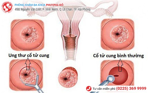 biến chứng mụn cơm hoa liễu